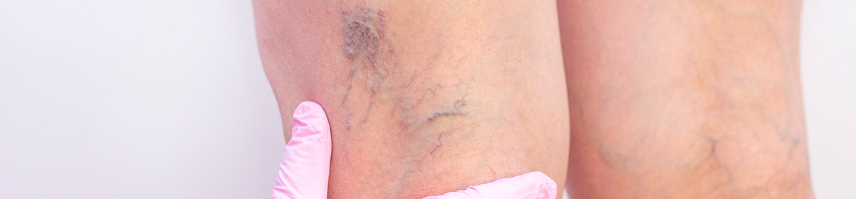 Com os avanços da medicina vascular ocorreu uma verdadeira revolução no tratamento de varizes, com soluções eficazes