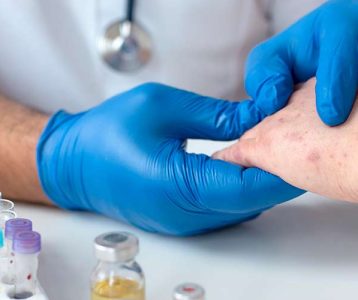 Melanoma cutâneo