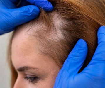 Alopecia areata